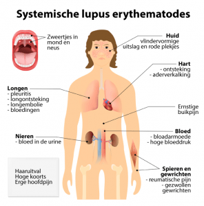 Systemische Lupus Erythematodes (SLE)