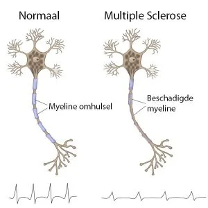 Multiple Sclerose (MS)
