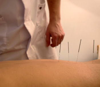 Acupunctuur voor endometriose