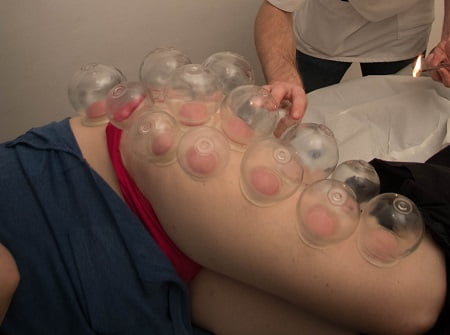Cupping bij cellulitis