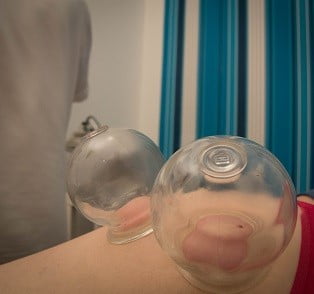 Cupping verlichten van pijn