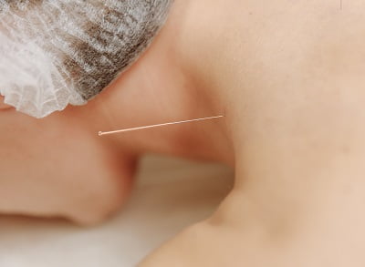 Long COVID acupunctuur