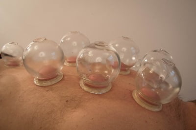 COVID cupping