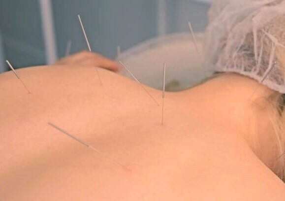 Acupunctuur bij spierspanning