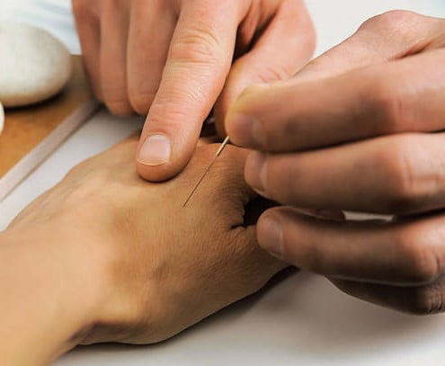 Acupunctuur bij ochtendmisselijkheid