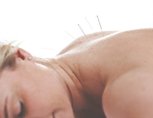 Duizeligheid behandelen met acupunctuur