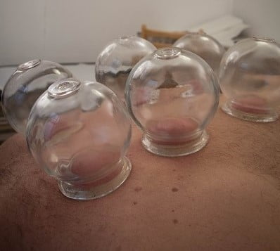 Hoe kan cupping helpen