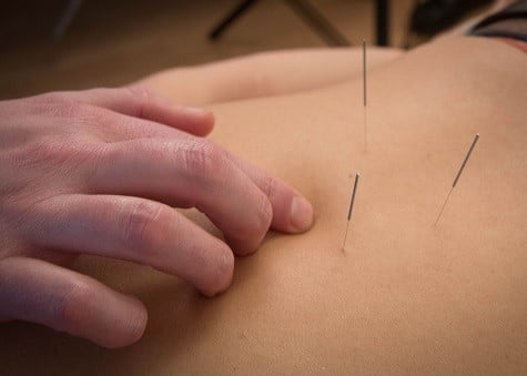 Periartritis en acupunctuur