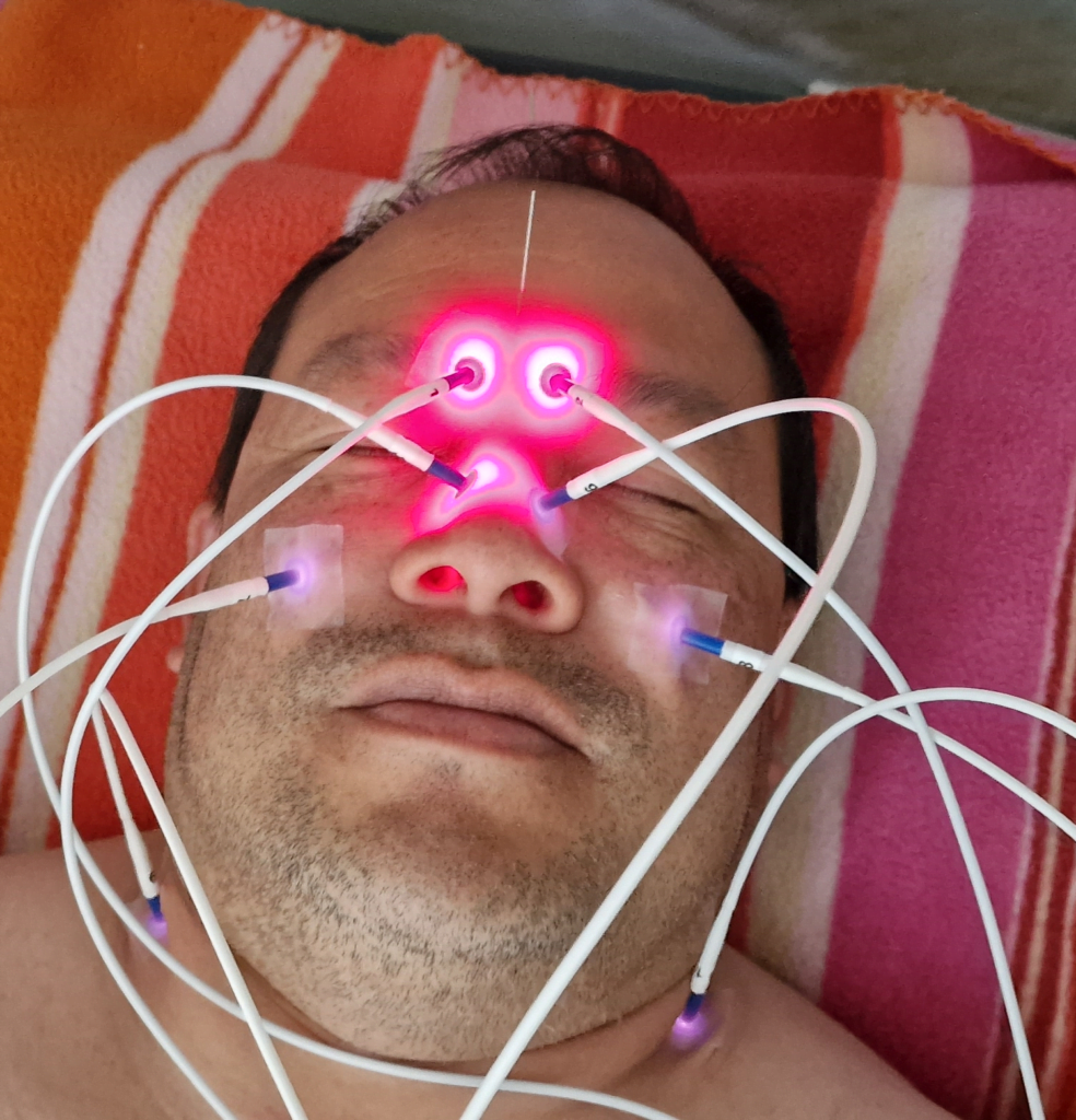Laseracupunctuur bij AHC Chen