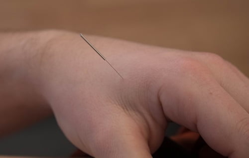 Hoe werkt acupunctuur hand AHC Chen